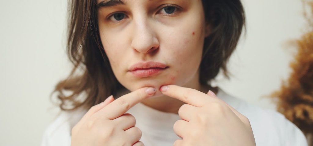 pimples vs cold sores