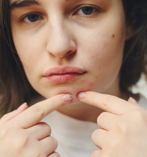 pimples vs cold sores