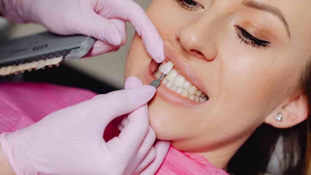 partial veneers before and after
