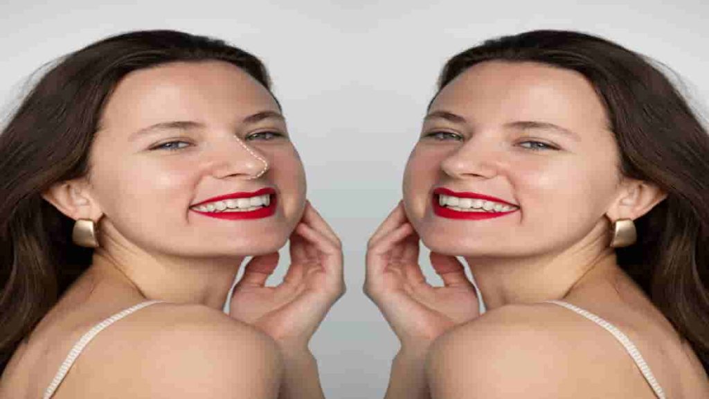 lip lift before and after