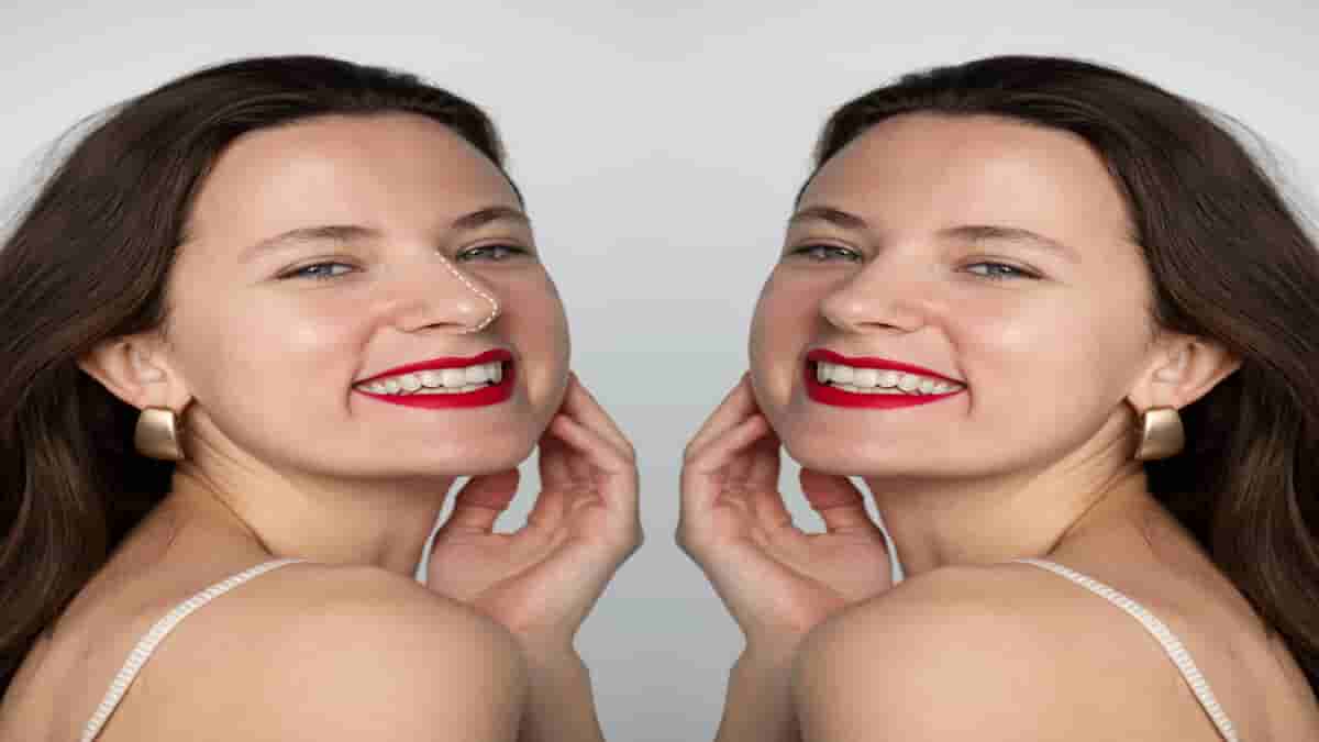 lip lift before and after