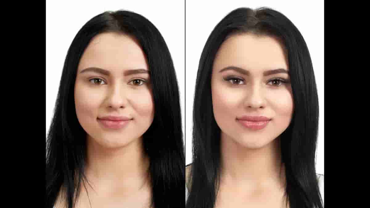 lip implant before and after