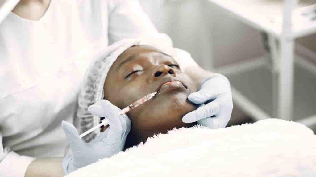 filler around mouth before after