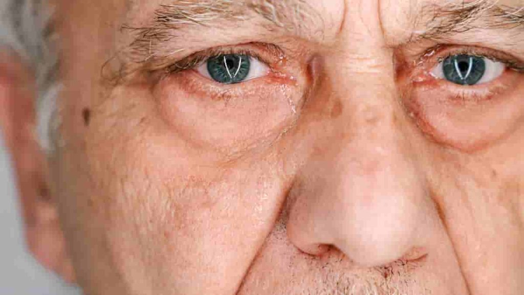 botox or fillers for under eye wrinkles