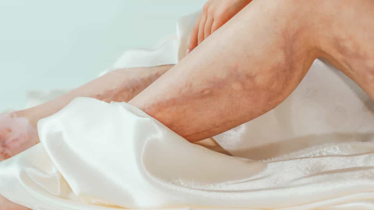 sclerotherapy before after