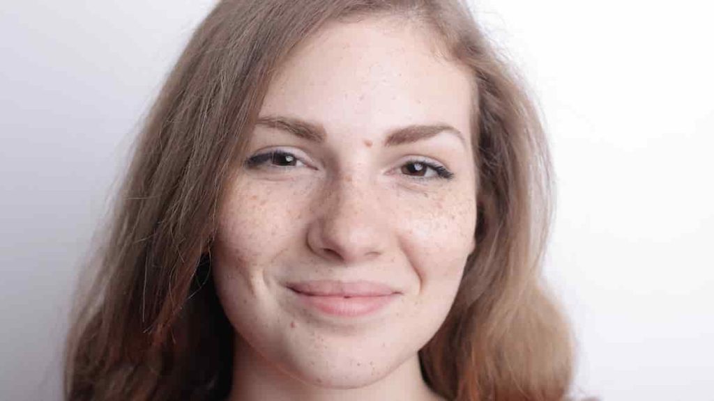 dark spots before after