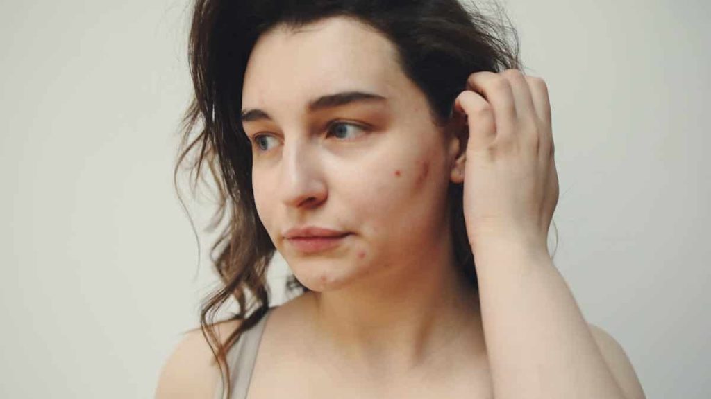 acne facial before after