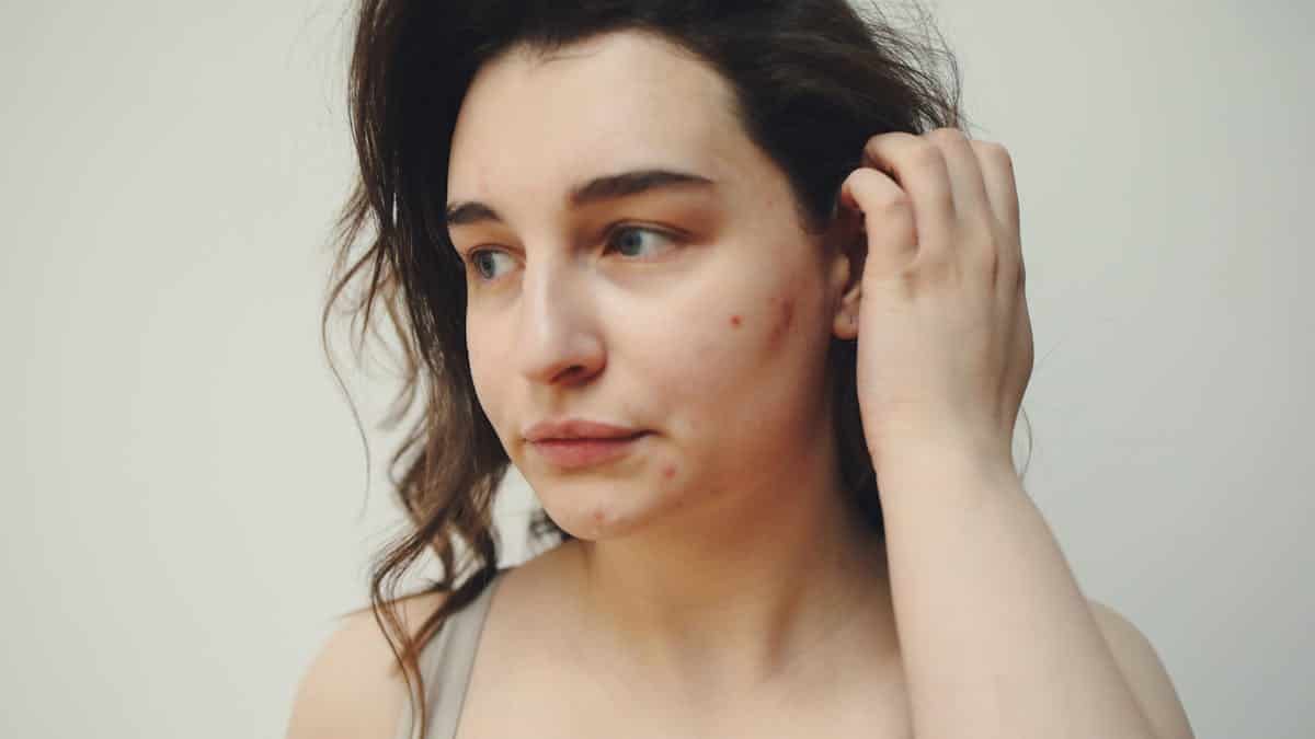 acne facial before after