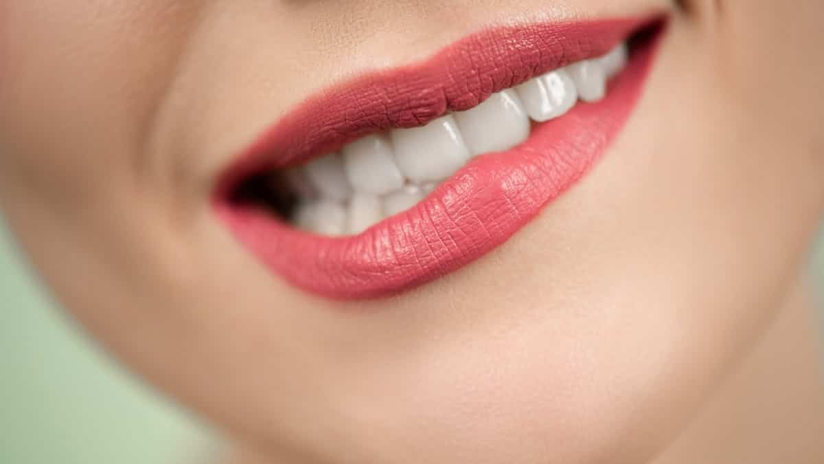 corner mouth lift before after